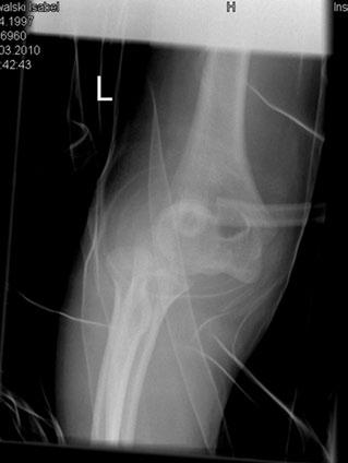 3 8 Röntgenaufnahme seitlich: Ellenbogengelenksluxation mit abgerissenem Epicondylus ulnaris Operationssaal unter Bildwandlerkontrolle nochmals radiologisch exakt zu