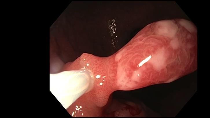 Gastritis B Hyperplastischer Polyp