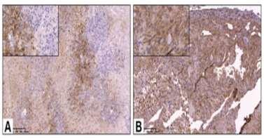 RT in Glioblastom- und Melanomzellen Kikuchi, M Oncoimmunol. 2017 Zr-89-PD-L1-PET/CT nach RT mit 4 10 x 2 Gy in HNSCC- und Melanom-Tiermodellen sign. PD-L1-Expr.