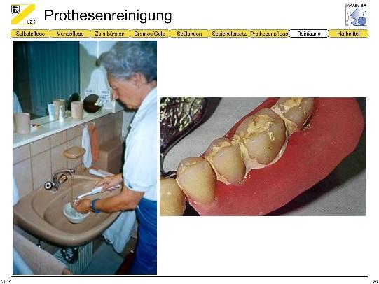 Patienten muss immer wieder gesagt werden, dass die Prothesen zur Reinigung aus dem Mund