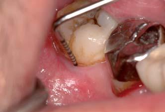 Wegen wiederholt aufgetretener Entzündungen haben wir dem Patienten zur Extraktion des Zahnes 48 geraten, da sowohl eine Tunnelierung als auch eine Prämolarisierung des