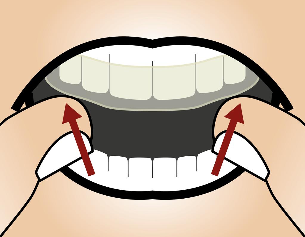 DIE ANWENDUNG IHRER OPTIMOTION THERAPIESCHIENE Einsetzen der Therapieschiene Führen Sie die Schiene komplett in den Mund ein.