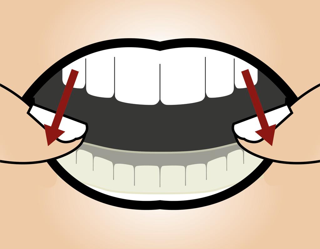Die Schiene rastet auf den Zähnen ein und sollte nun festsitzen.