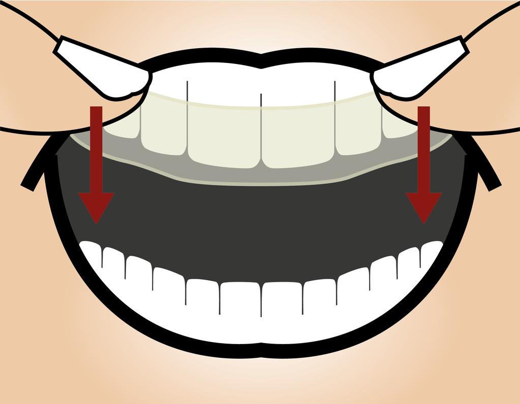 Herausnehmen der Therapieschiene Die Therapieschiene sollte durch geringe Kraftausübung vom Zahnbogen lösbar sein.