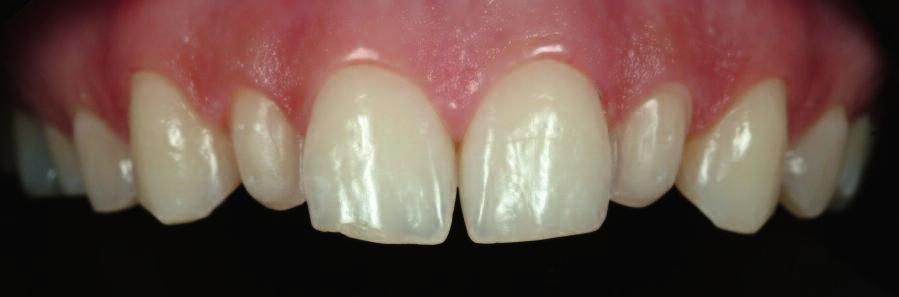 Die lückig stehenden Zähne in der Oberkieferfront sollten geschlossen und die Länge der seitlichen Schneidezähne dem Verlauf der Einser und Dreier angepasst werden.