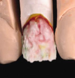 Dieser Bereich läuft nach inzisal dünn aus. Die Lichtbrechungskante wird inzisal mit FD-91 (bei hellen Zahnfarben) abgedeckt (Abb. 20).