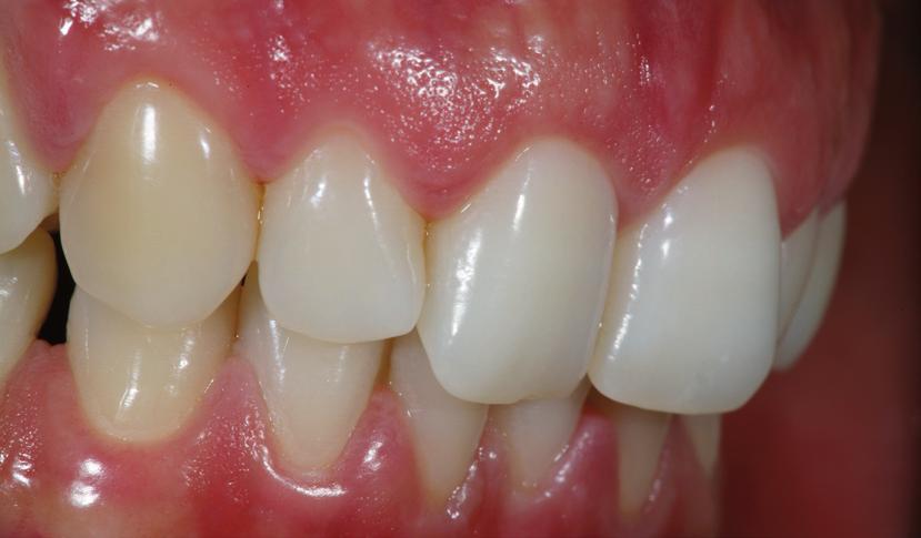 Reflex dimension Gingiva Massen Anwendungsbereich Die Gingiva Dentine ermöglichen durch ihre Farbvielfalt (sechs unterschiedlich eingefärbte Massen) die exakte farbliche Rekonstruktion der Gingiva.