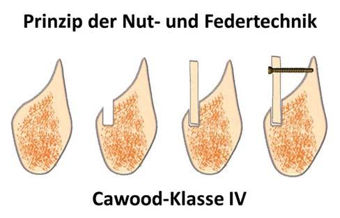 Abb. 1: Nut-Feder-Technik. die Retromolarregion, der gleichen Seite an.