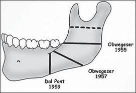 nach Obwegeser-DalPont, die eine stufenförmige Osteotomie im aufsteigenden Ast, Kieferwinkel und posterioren Unterkieferkörper beschreibt.