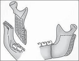 Die Obwegeser-Osteotomie wird vorwiegend bei UK-Rückverlagerungen mit Betonung des Kieferwinkels durchgeführt, wohingegen die erweiterte Technik nach Obwegeser-DalPont für UK-Vorverlagerungen gewählt