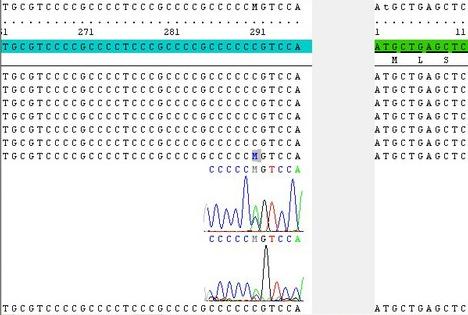4. Ergebnisse Eine Person wies einen bekannten Austausch von Cytosin zu Adenin an Position c.-6 auf. Die Variante befindet sich sechs Basen vor dem Translationsstartcodon.