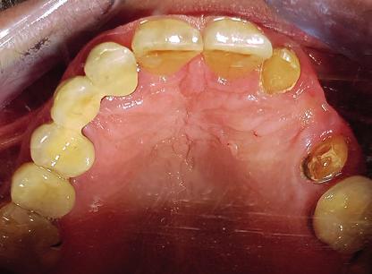 Jan Philipp Struckmeyer Der Verlust von Zähnen, sei es aufgrund eines Traumas oder einer Pathologie, geht mit einem gleichzeitigen Verlust des umgebenden Alveolarknochens einher.
