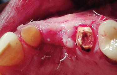 6 und 7: Situation nach Lappenpräparation, Implantation und Fixation der Knochenplatte mit zwei Osteosyntheseschrauben. Abb.