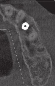 verwenden. Um ein zusätzliches OP-Gebiet zu vermeiden, wurde der Lappen soweit wie nötig tunnelierend erweitert, um eine Entnahme der Knochenplatte mittels Piezochirurgie zu ermöglichen.