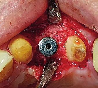 Ihr Wunsch war eine implantatgetragene Lösung, um eine bessere Reinigung durch Zahnseide zu Abb. 19 Abb.