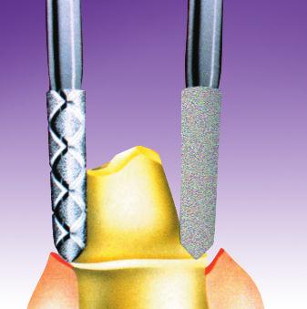 Wahl des passenden Instruments Die Präparationsform hängt von der Form des verwendeten TDA Diamantinstruments ab.