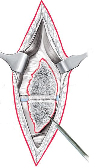 Die posterolaterale Längsinzision von ca. 2 cm Länge wird dicht lateral neben der Achillessehne geführt (d), um den N. suralis nicht zu verletzen.