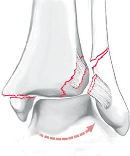 eine additive axiale Stauchung bei gleichzeitig dorsalextendiertem Fuß zur Impaktion