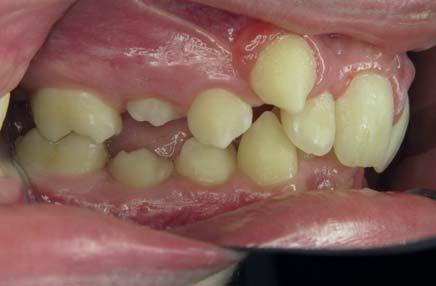 9: Trotz 21 Monaten Behandlung mit herausnehmbaren Apparaturen konnte keine wahrnehmbare Zahnbewegung erreicht werden.