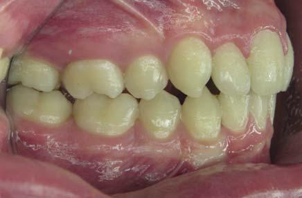 Besser für die Patientin wäre es gewesen, das Ende des Zahnwechsels abzuwarten, um die Behandlung mit MB-Apparatur in 12 Monaten zu lösen. Wie soll es weitergehen?