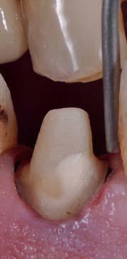 Anschließend wird mithilfe einer Reihe von Gates-Glidden- und Largo-Bohrern mit zunehmenden Durchmessern der Großteil des endodontischen Füllmaterials beseitigt und der Wurzelkanal grob vorbereitet.