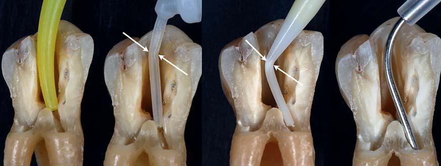 Colibri im anterioren Bereich mit Zementierung und Stiftaufbau Die Verwendung des individuell an die anatomische Form der Wurzel angepassten Mikroinstrumentariums stellt einen weiteren Erfolgsfaktor