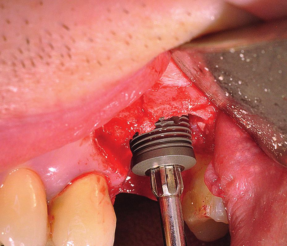 Implantatlänge 7 mm 9 mm mm Vorläufige Ergebnisse 9 mm-implantat bei Weitem am häu figsten verwendet wurde, und das 99 Patienten wurden mit einem Implan deutet darauf hin, dass diese Länge tat
