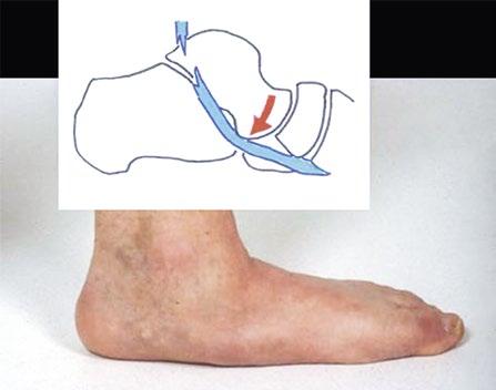 Die Patienten haben Mühe beim Gehen und weisen von sich aus auf eine Änderung ihrer Fussform hin. Bei zunehmender Deformität klagen die Betroffenen darüber, «neben dem Schuh zu stehen».