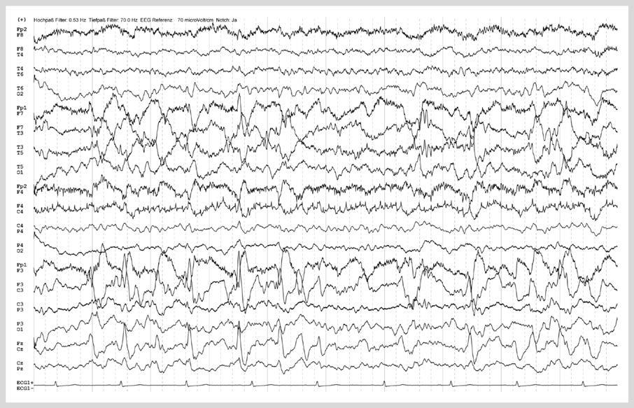 126 Originalia Abb. 1 EEG bei einem Patienten mit NKSE bei Frühkindlichem Hirnschaden. Abb. 2 EEG bei einer Patientin mit nichtlimbischem nonkonvulsivem Status epilepticus und hochfrequenten regionalen epilepsietypischen Mustern.