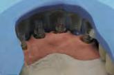 Für die genaue Aufstellung bei implantatgetragenem Zahnersatz eignen sich die visio.lign Verblendschalen ideal.