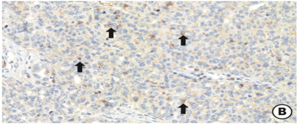 inkomplett PD-L1 expression auf intraepithelialen TILS (schwarze