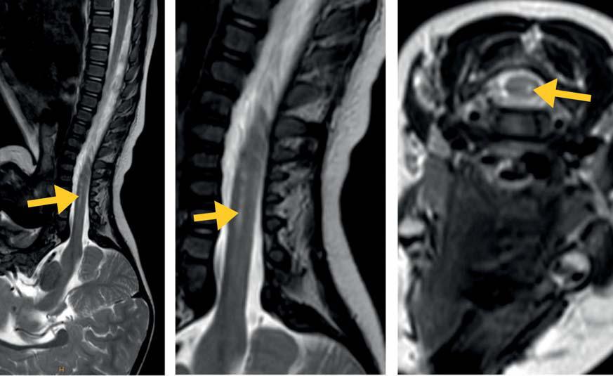 Abbildung: Die Magnetresonanztomographie des Halsmarks zeigt ein relativ scharf begrenztes Myelopathiesignal im Bereich der linkseitigen Vorderhornzellen der grauen Substanz (sagittale T