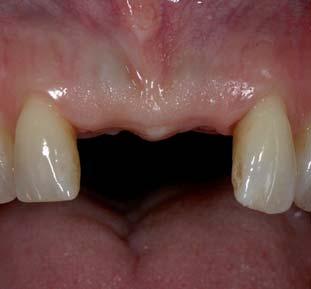 zahnmedizin cosmetic dentistry/ästhetische chirurgie Abb. 5 Abb. 6 Abb. 7 Abb. 5: Ausgangssituation nach Verlust der beiden mittleren Frontzähne.