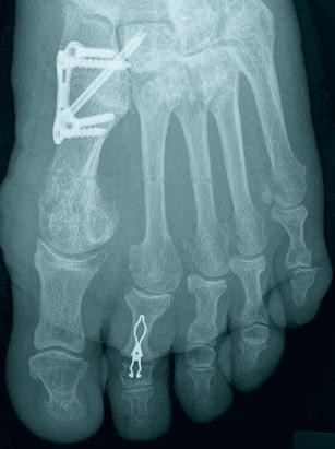 Arthrodese des Zehenmittelgelenks) metatarsalen Osteotomie großzügig gestellt werden, um die Belastung auf das Zehengrundgelenk zu reduzieren und einem Fehlstellungsrezidiv vorzubeugen.