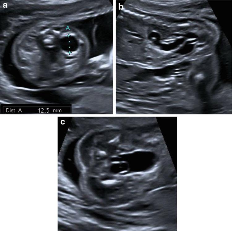 11 (a,b) Sonographische Darstellung eines Feten mit einer posterioren Urethralklappenstenose in der 21.