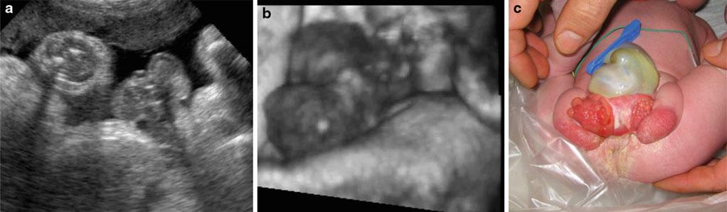 Abb. 12 (a,b) Darstellung eines Feten mit einem Prune-Belly-Syndrom in der 14. SSW (a) und 18. SSW (b). Megazystis mit massiv aufgetriebenem Abdomen. Die Schwangerschaft wurde beendet Abb.