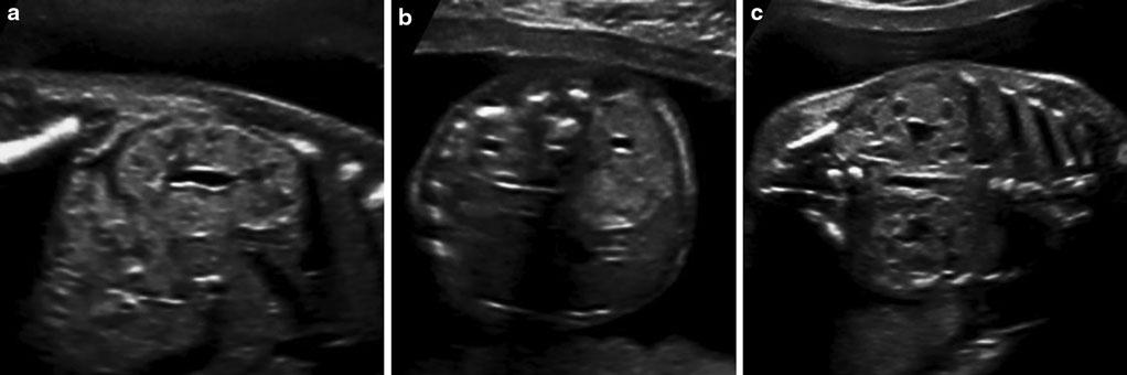 2 (a-c) Sonographische Darstellung der fetalen Niere mit 20 Schwangerschaftswochen in verschiedenen Einstellungsebenen: (a) sagittal, (b) transversal, (c) frontal Nierenwachstum etwa 1,1 mm pro SSW.