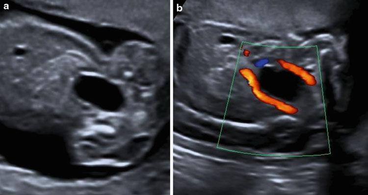 4 (a,b) Sonographische Darstellung der ellipsoidförmigen Harnblase (a) und Darstellung der beiden perivesikal verlaufenden umbilikalen Arterien (b) Die fetale Urinproduktion beginnt zwischen der 8.