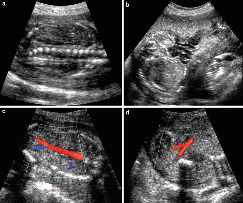 Abb. 6 (a-d) Sonographische Darstellung eines Feten mit einer bilateralen Nierenagenesie. a Fehlende Nierendarstellung in der paravertebralen Ebene.