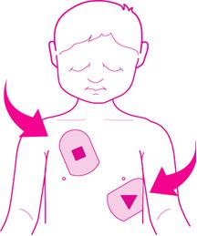 b. Wenn der Brustkorb des Kindes groß genug ist, dass ein Abstand von 2,5 cm zwischen den Elektroden eingehalten werden kann, können die Elektroden ähnlich wie bei einem Erwachsenen positioniert