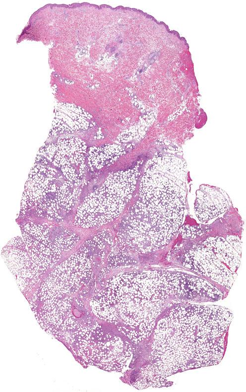 Die LyP Typ C, welche sich ebenfalls mit kohäsiven Verbänden CD30-positiver pleomorpher und anaplastischer lymphoider Zellen manifestiert, erfolgt aufgrund der klinischen Präsentation mit