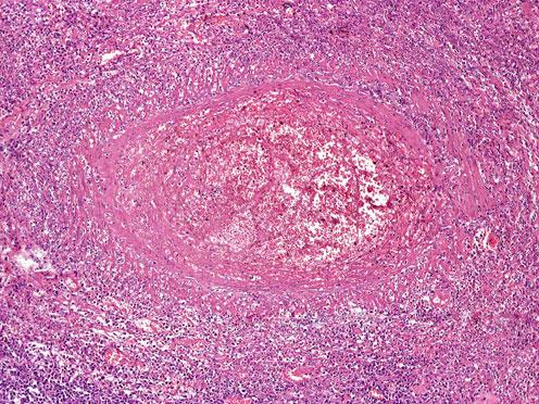 21 Extranodales T/NK-Lymphom vom nasalen Typ: Angiozentrisches und angiodestruktives Wachstum mit Durchsetzung und Zerstörung der Gefäßwände durch Tumorzellen (HE) und des Gaumens mit mutilierenden