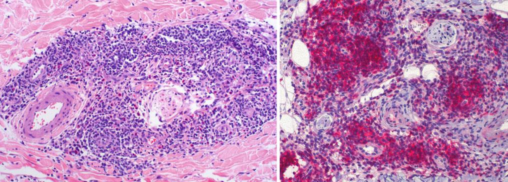 Abb. 27 Angioimmunoblastisches Lymphom, kutaner Befall: Dichte dermale perivaskuläre Infiltrate vorwiegend kleiner, teils atypischer Lymphozyten (links; HE) mit Expression von PD-1 durch die