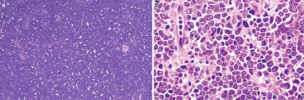 myeloischen Leukämie der FAB-Subtypen M0, M1, M2 und M3 und bei der chronischen myeloischen Leukämie (CML) vor.