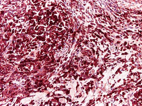 Abb. 44 Akute myeloische Leukämie. Die neoplastischen Zellen (Promyelozyten, Myelozyten) zeigen eine Reaktivität f ur Myeloperoxidase (Immunhistochemie DAB) und segmentierte neutrophile Granulozyten).