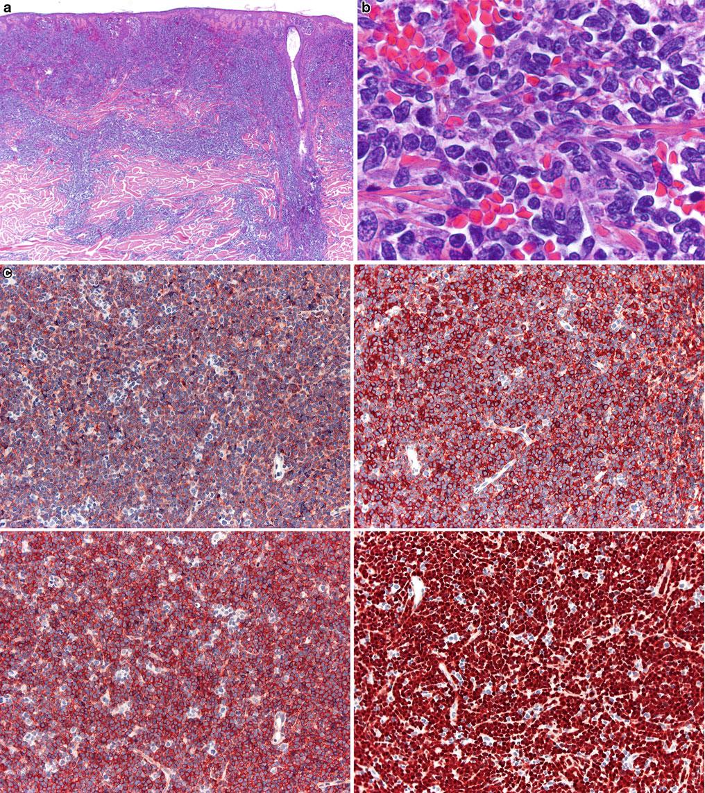 Abb. 45 a-c Blastäre Neoplasie plasmazytoider dendritischer Zellen: a Dichte diffuse dermale Infiltrate und intratumorale Erythrozyten-Extravasate, b blastäre