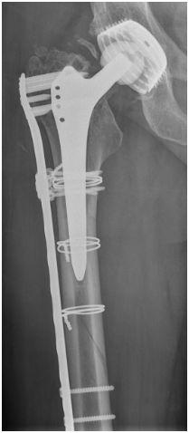 Die anatomisch vorgeformten Implantate können über einen Zielbügel perkutan mit monokortikalen Schrauben besetzt werden (Gruner et al.