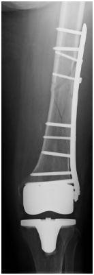 4e, f: drei Monate postoperativ Röntgenbilder der Klinik für Unfallchirurgie, Orthopädie und Plastische