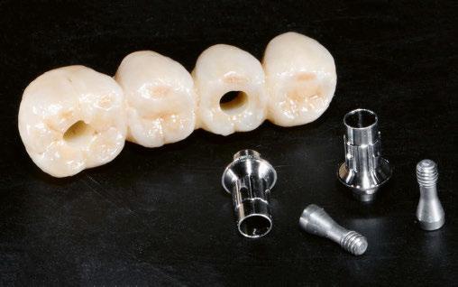 Als arameter eines individualisierten Abutments gelten das Weichgewebe-Durchtrittsprofil, die Lage des Kronenrandes, gemessen vom Zahnfleischsaum oder von der Implantatschulter, die Ausformung der