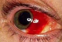 Contusio bulbi (vordere Augenabschnitte) Hyposphagma Ruptur Bindehautgefäss Schwere Verletzungen: Skleraruptur, Fremdkörperverletzung, fortgeleitet von Orbitahämatom